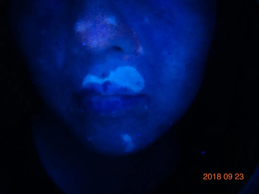 白癜风治愈一百例,白癜风治愈患者分享痊愈经验