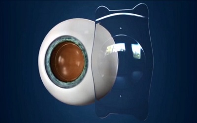 做近视手术老了之后有什么弊端,飞秒激光近视手术的弊端