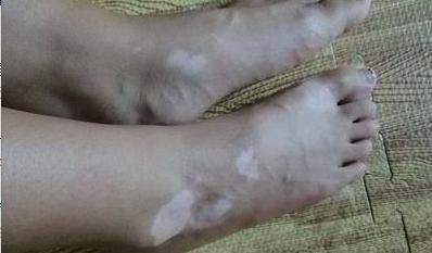 肢端白癜风最佳治疗方法,肢端型白癜风怎么治疗最好