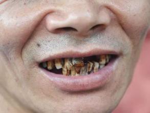 吃槟榔对身体造成什么严重的后果,吃一年槟榔脸上有什么变化