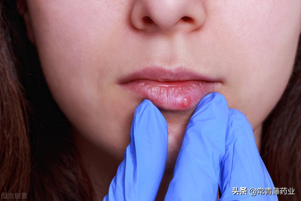 嘴唇上每年都长疱疹是遗传吗,嘴唇疱疹接吻会传染吗
