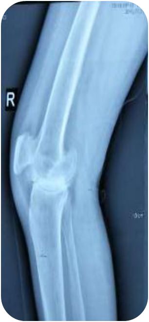 小针刀帮大忙，畸形3年伸不直的膝盖终有治