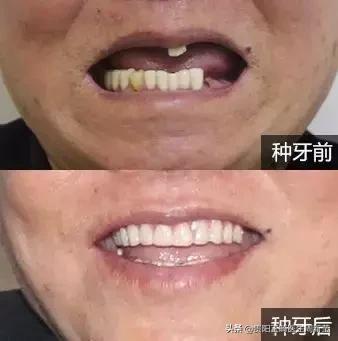 烤瓷牙十几年了有必要更换吗,烤瓷牙套里的牙烂了有什么症状