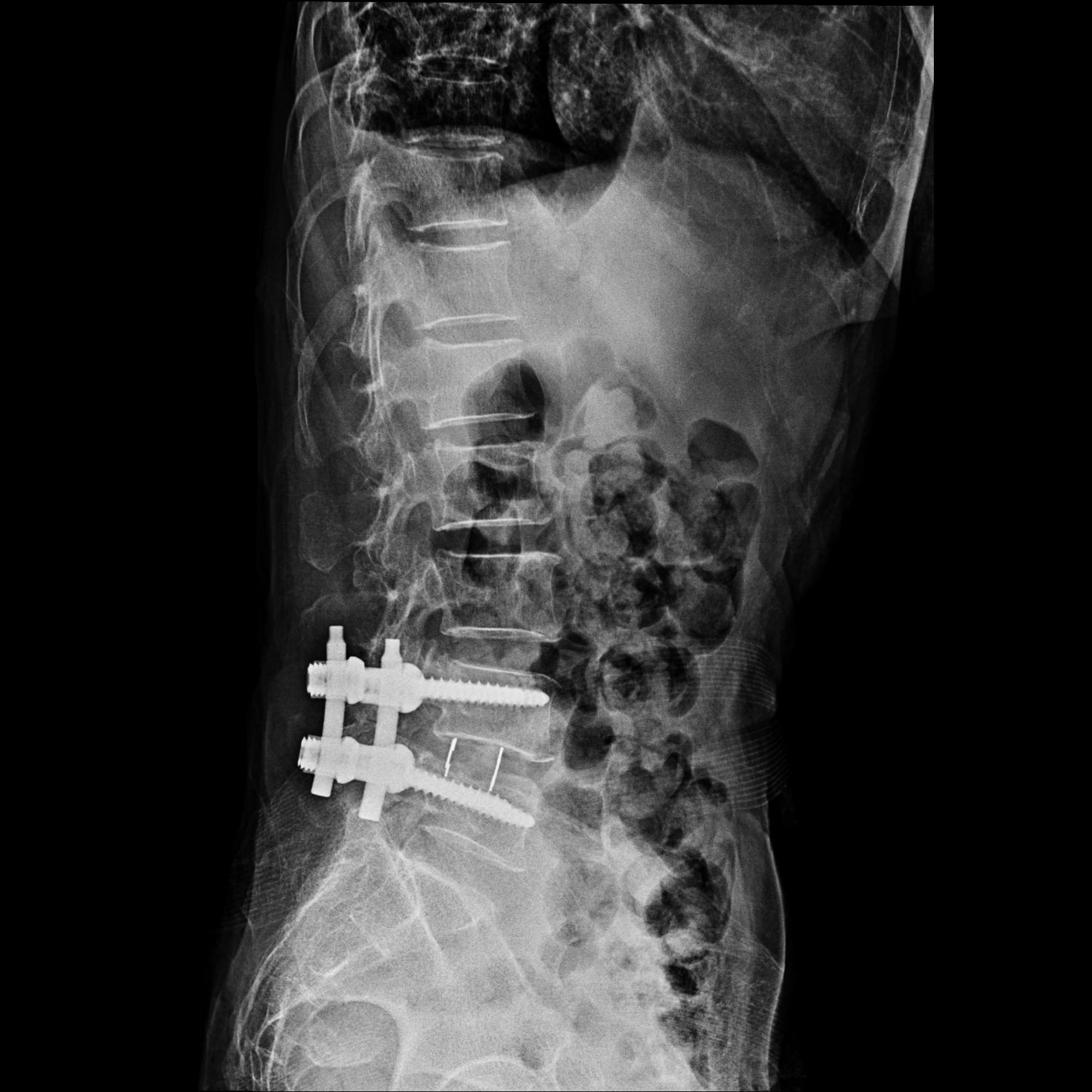 腰痛只知道椎间盘突出？那就有点out了