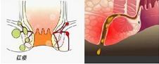 了解肛瘘的相关知识,门诊肛瘘
