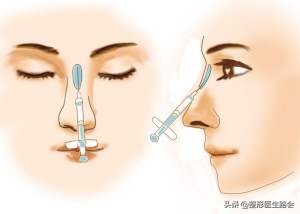 玻尿酸填充鼻子后悔了,玻尿酸注射后悔打溶解酶会不好吗