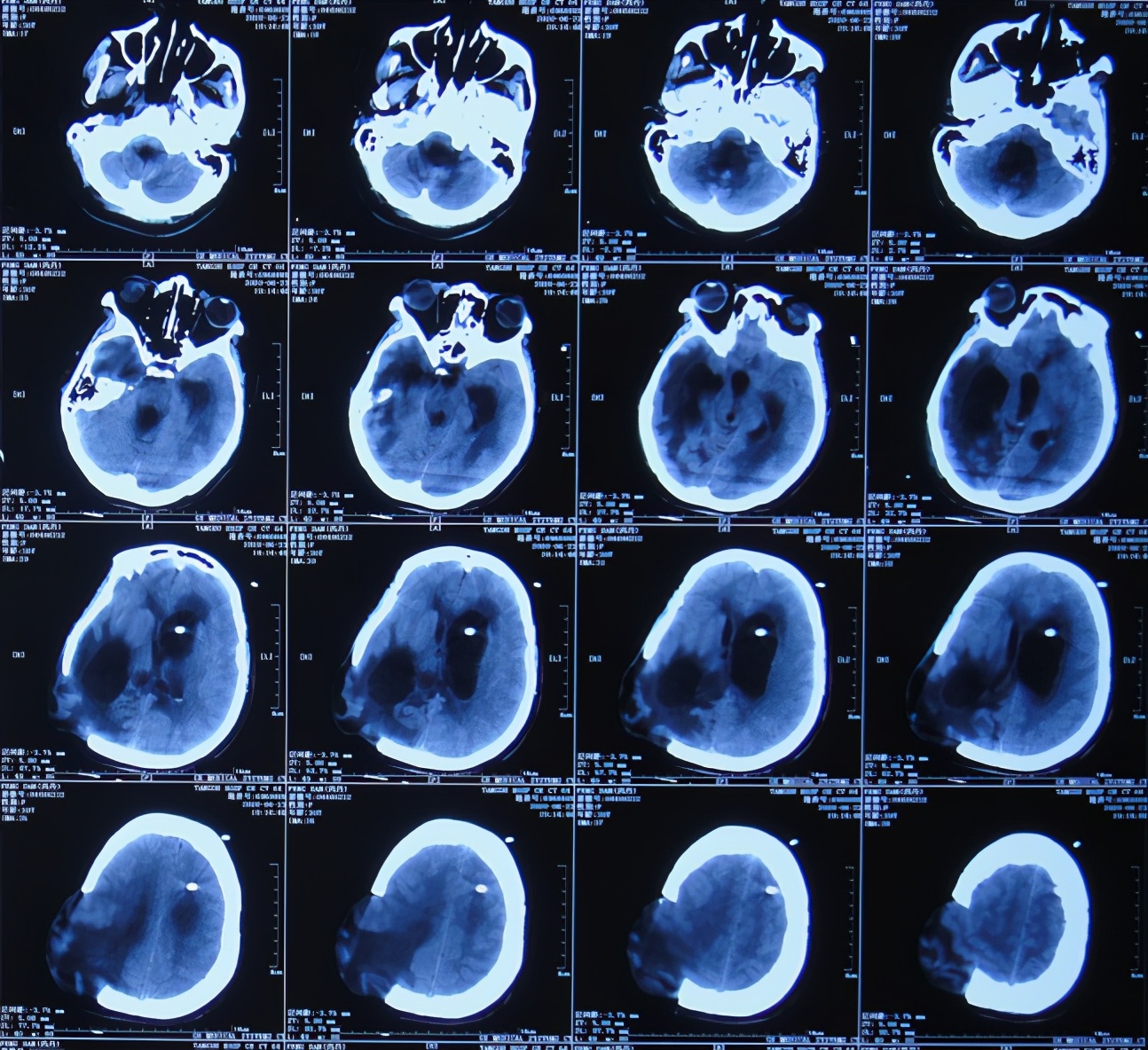 脑室有粘连脑积水有什么办法,脑动脉畸形手术后出现急性脑积水