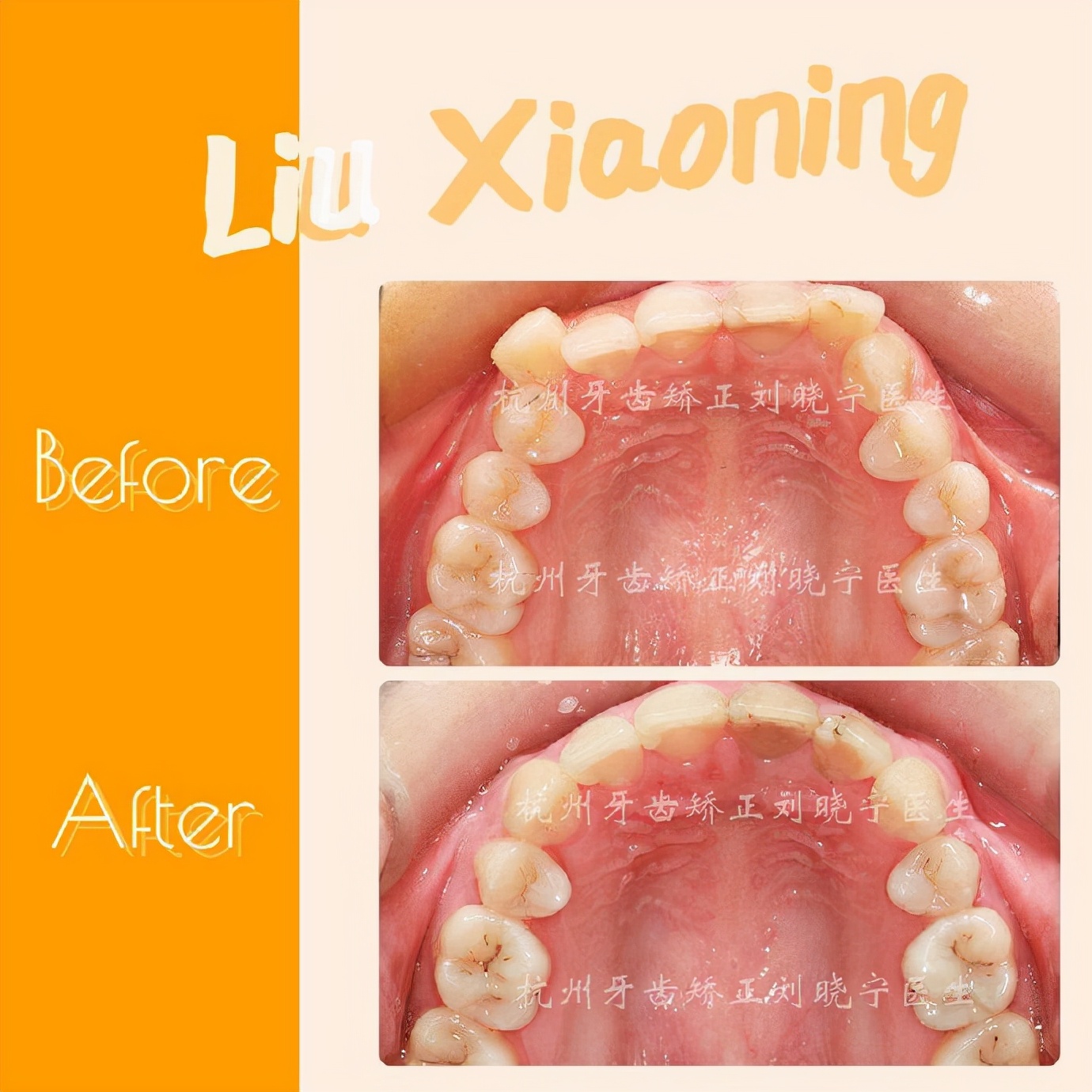 杭州舌侧牙齿矫正,舌侧矫正杭州价格