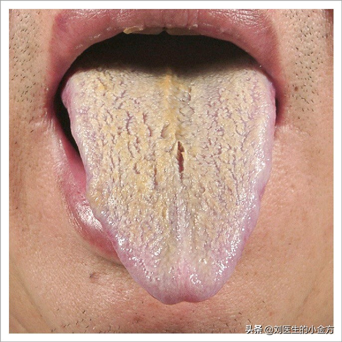 舌象图解大全中医舌诊,最全中医舌诊图谱来了