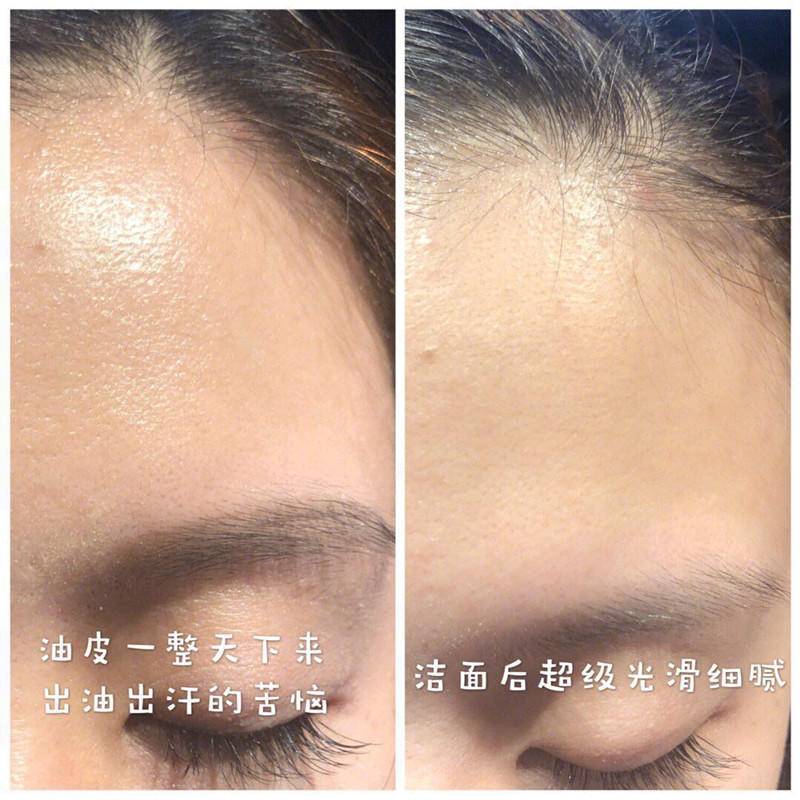 去黑头粉刺比较有效的方法,去黑头粉刺的最简单方法