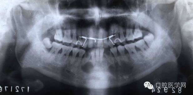 根尖周炎能自愈吗,根尖周炎x光图片