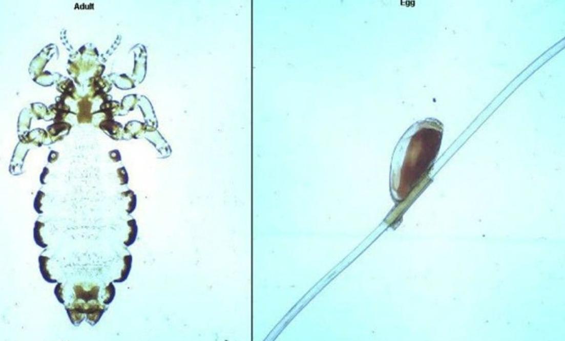 30年前每个人身上都有虱子,30年前人人都有的虱子为什么不见