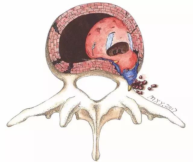 治疗腰间盘突出的最好锻炼方法,治腰间盘突出的最佳锻炼方法视频