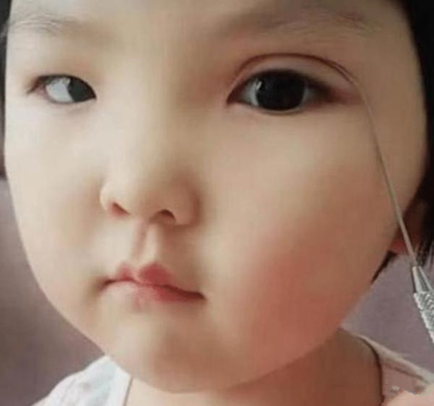 妈妈强行给1岁女儿割双眼皮,妈妈给割双眼皮