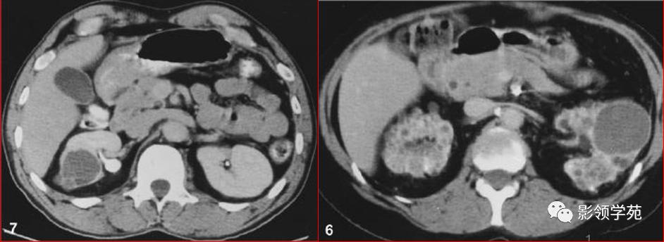 肾脏囊性肿块的影像学特点,肾脏典型病理图片及解析