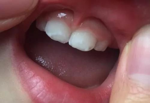 牙齿有白色斑点怎么办,孩子牙齿出现白色怎么回事