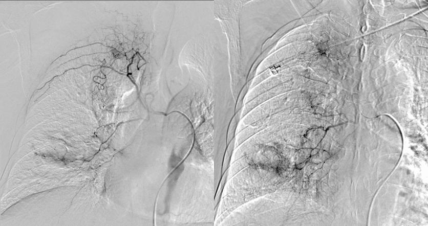 肺鳞癌介入治疗成功率,肺鳞癌最好的免疫化疗方案