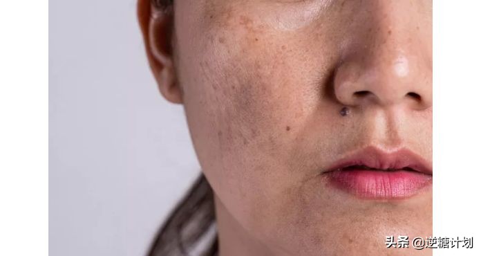 油性肌肤夏天适合什么护肤品,油性皮肤夏天怎么改善出油