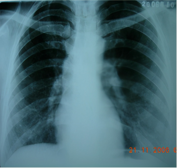 养鸽子造成皮肤真菌感染,养鸽子会得肺炎吗