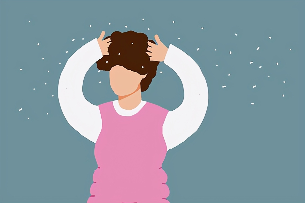 头皮大面积皮屑是怎么回事,干性头皮屑和脂溢性皮屑