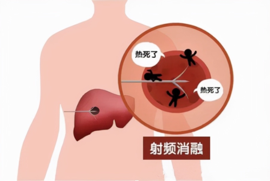 肿瘤介入微创疗法要多少钱,微创治疗肿瘤有哪些手段