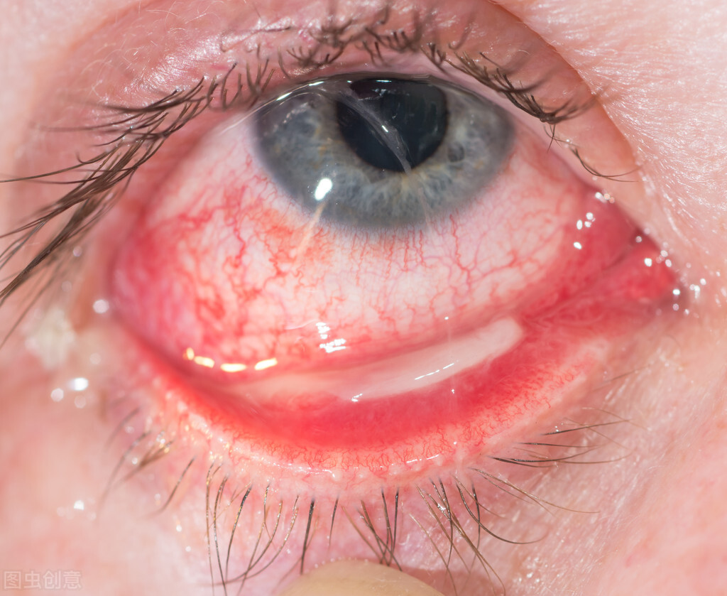 戴隐形眼镜刺痛流眼泪睁不开,戴隐形眼镜眼角流脓