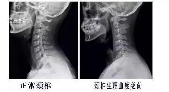 颈椎病曲度变直怎么治疗,低头族颈椎矫正的方法视频
