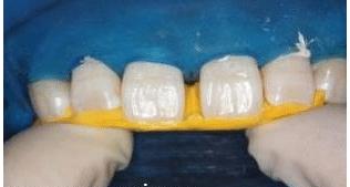 门牙裂了一条缝,门牙有缝的女人