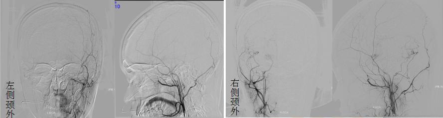 医生给脑血管搭桥,外科医生给年轻女孩做手术