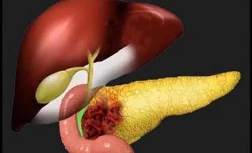 儿童胰腺炎指南共识,急性胰腺炎科普小课堂