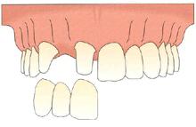 做了烤瓷牙后悔了有补救办法吗,做了烤瓷牙后悔了怎么补救