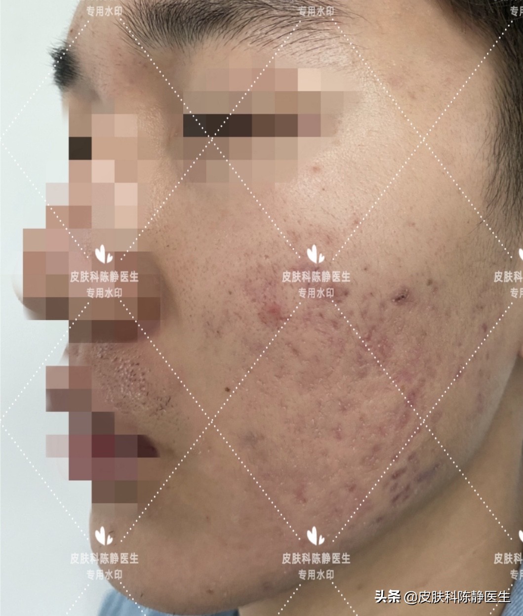 治疗脸部痤疮中医好还是西医好,传统治疗痤疮