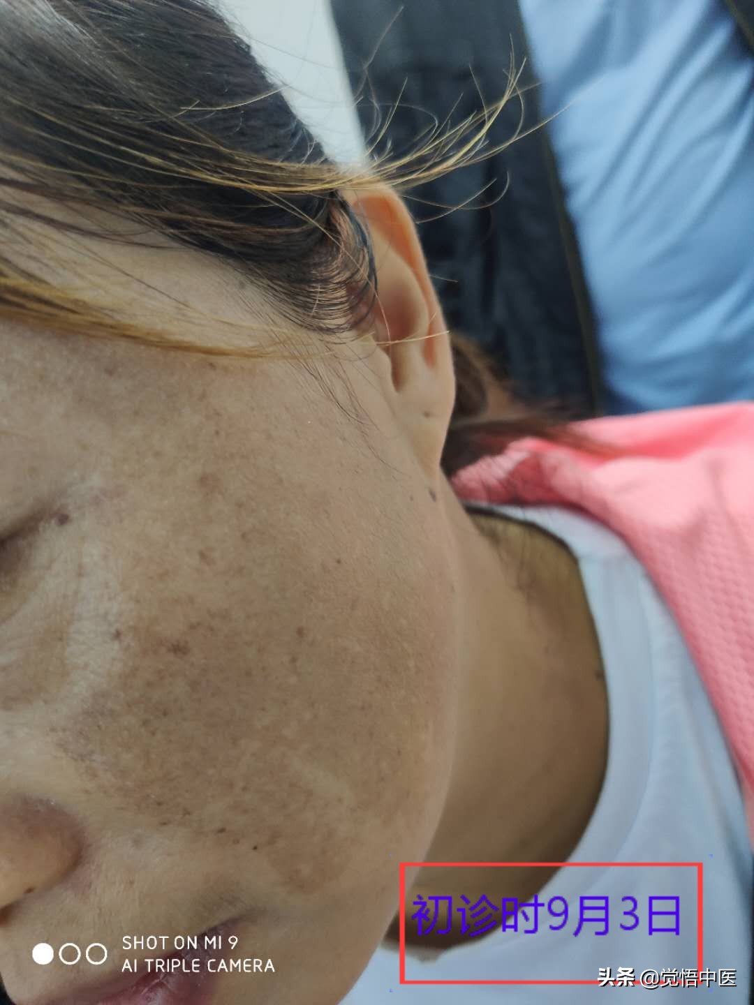 褐青色斑中医疗法,褐斑治疗药物