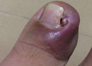 脚趾甲嵌进肉里面原因,脚趾甲长肉里拔不出来怎么办