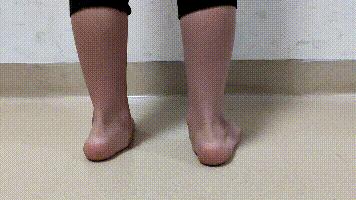 扁平足如何影响体态,扁平足会影响长高吗