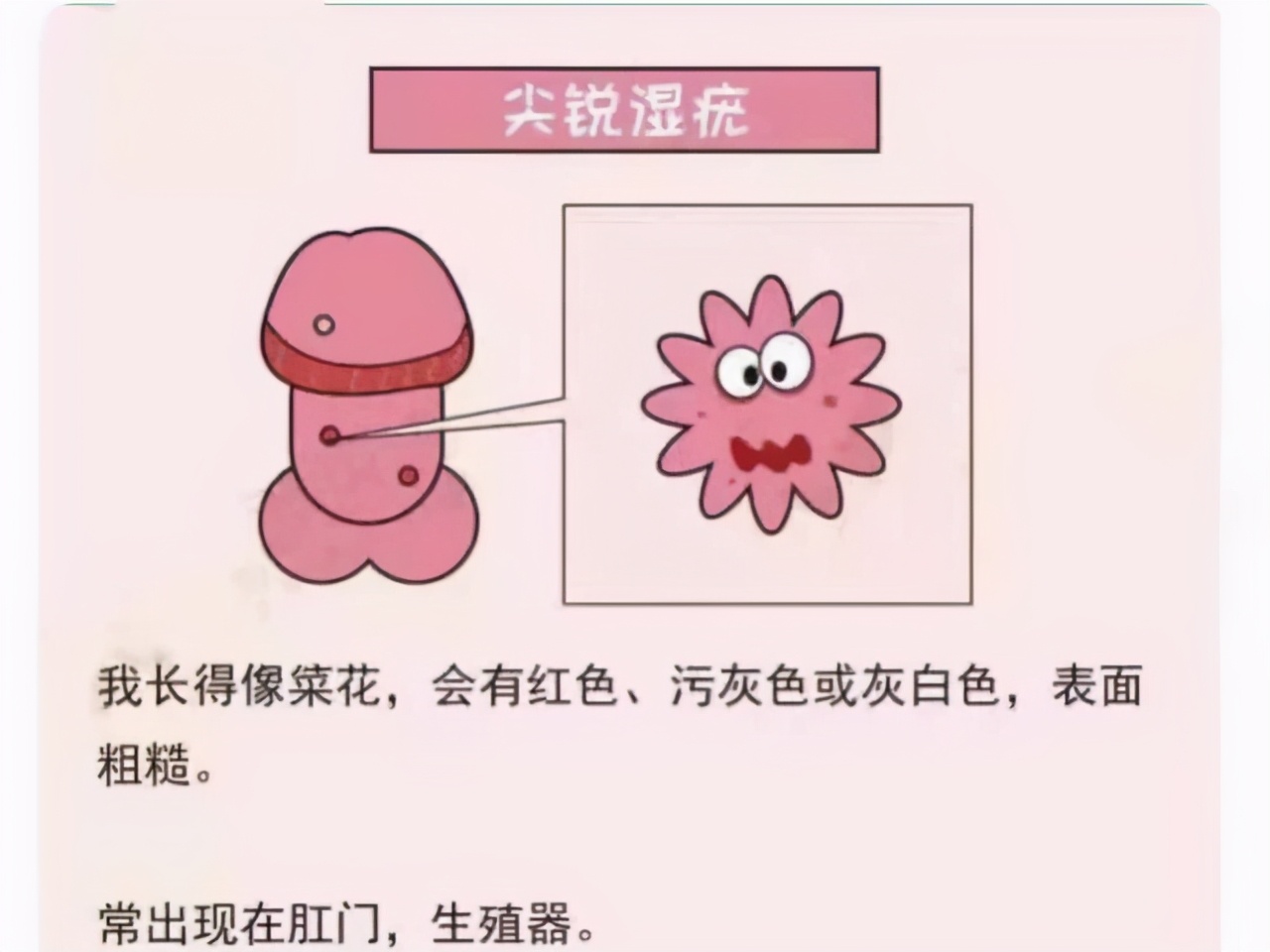 尖锐湿疣可以用药物治疗吗？