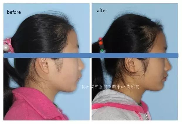 牙齿深覆合对脸型的影响,覆合型牙齿是怎么造成的