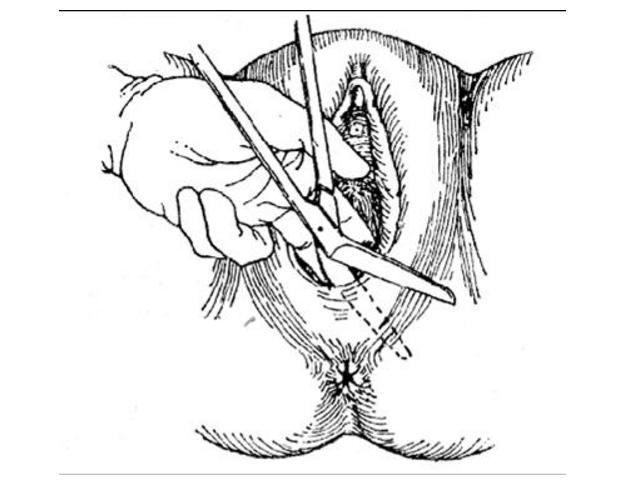 产妇“侧切”后影响夫妻生活？产科医生给出解释，并提出建议