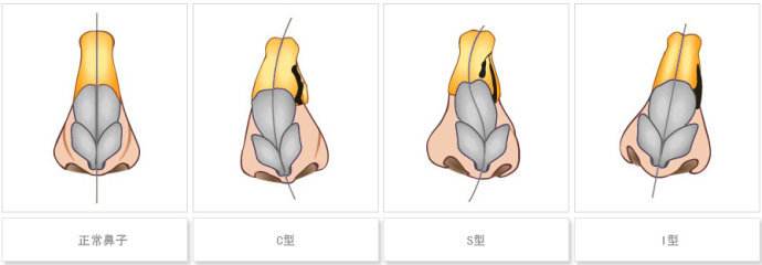 鼻子畸形怎么办,鼻畸形可以整正常吗