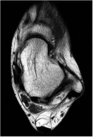 踝关节撞击症问诊,踝关节内侧撞击综合症位置图