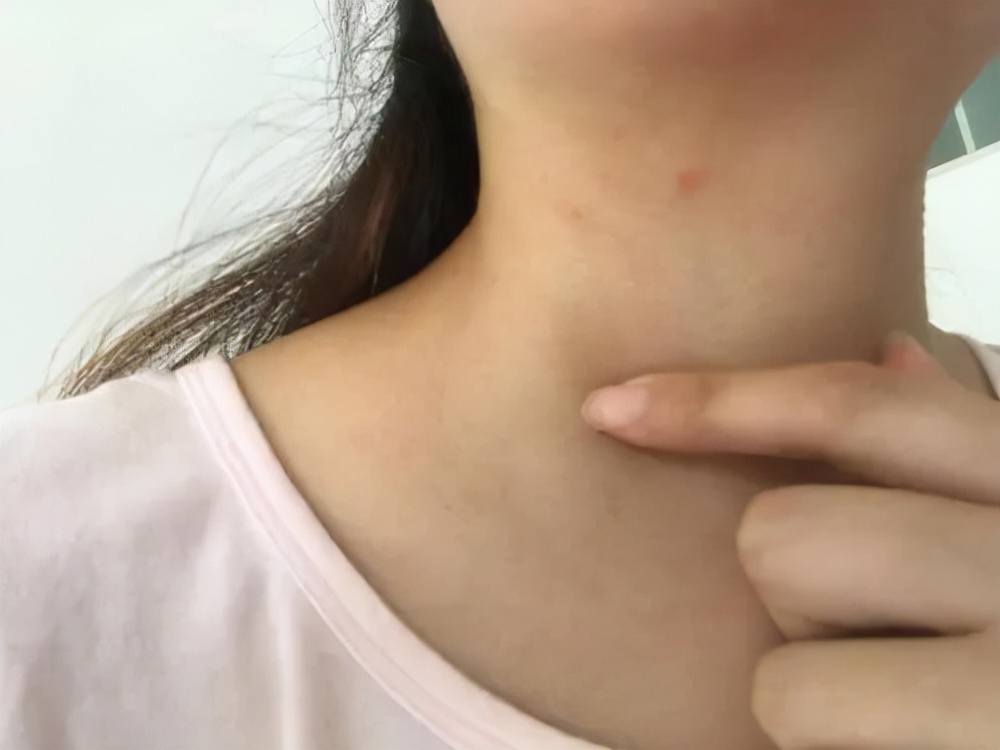 宫颈癌腿上皮肤有4个征兆,宫颈癌会引起皮肤瘙痒起红疙瘩吗