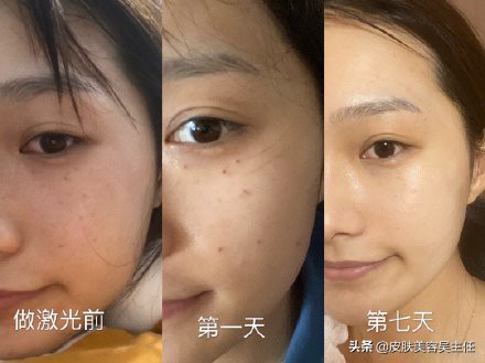 激光可以彻底祛斑吗多少钱,激光祛斑做几次彻底去掉斑