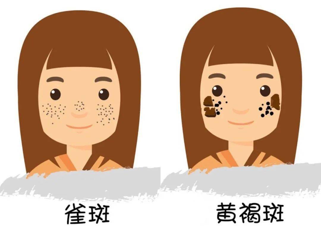 褐青斑是什么原因形成的,褐青色斑产生的原因