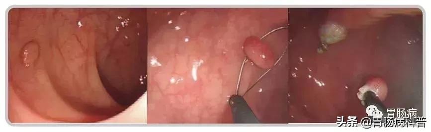 长了胃息肉怎么办,长了胃息肉怎么办才好