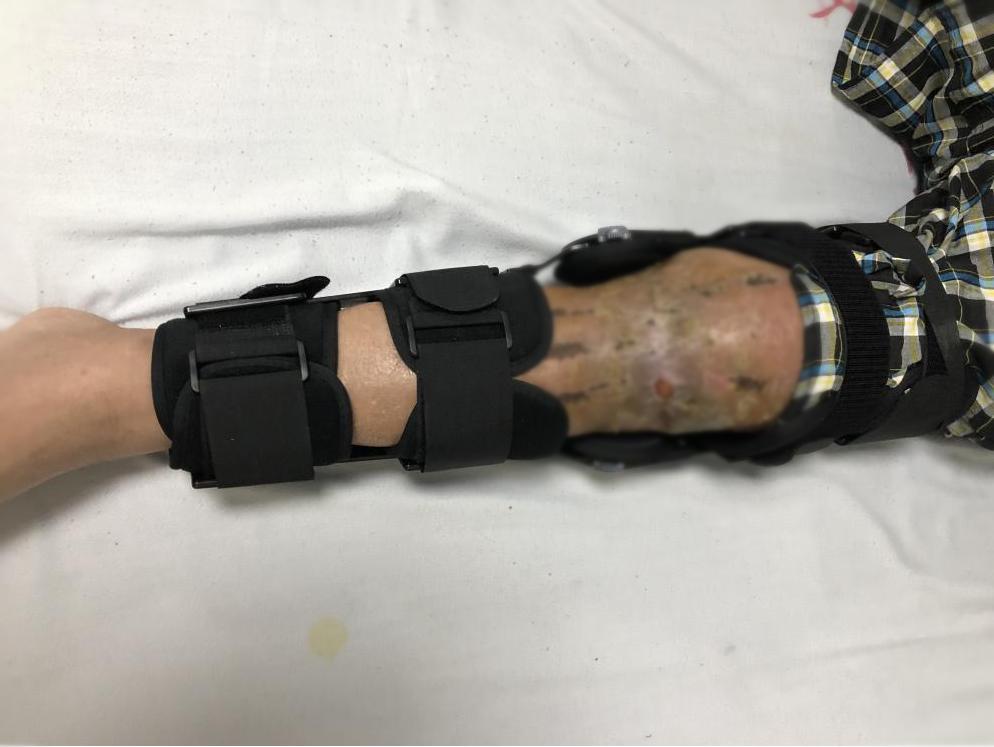 男士膝盖破了怎么办,膝关节破了个洞