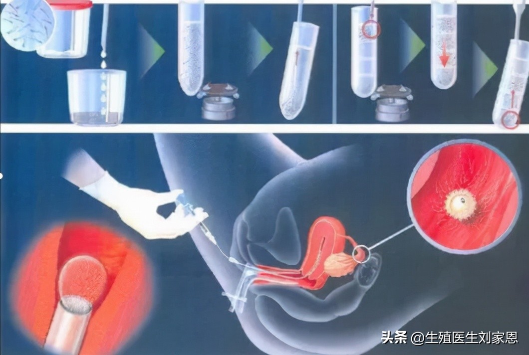 附睾切除就是把整个睾丸切除吗,附睾切除一个还可以生育吗