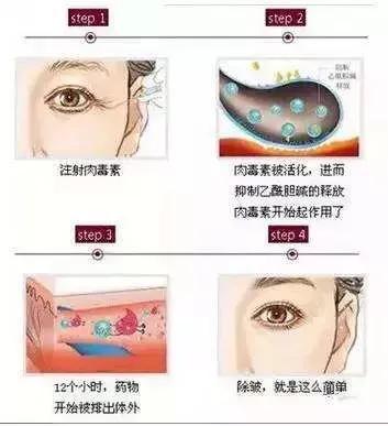 探讨一下肉毒毒素的管理要求,肉毒毒素正确的使用方法