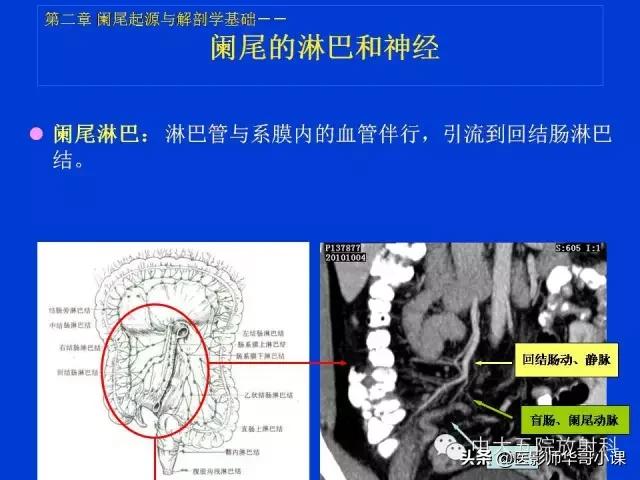 阑尾炎课件,阑尾炎的超声课件