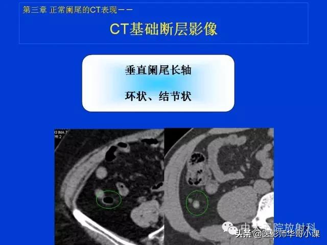 阑尾炎课件,阑尾炎的超声课件