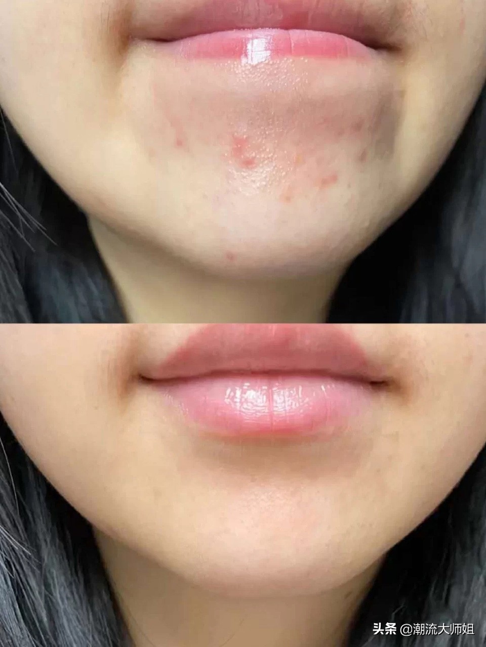 怎样才可以彻底告别痘痘肌,三招教你告别痘痘肌的烦恼